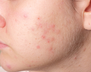 Acne on the girl's face. Image close-up
