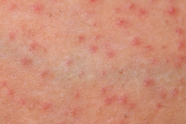 聯合新聞網 | 健保皮膚病就醫指南3／濕疹病灶在皮膚 改善卻靠睡眠